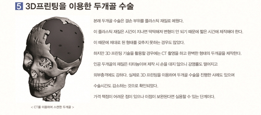 3D프린팅을 이용한 두개골 수술