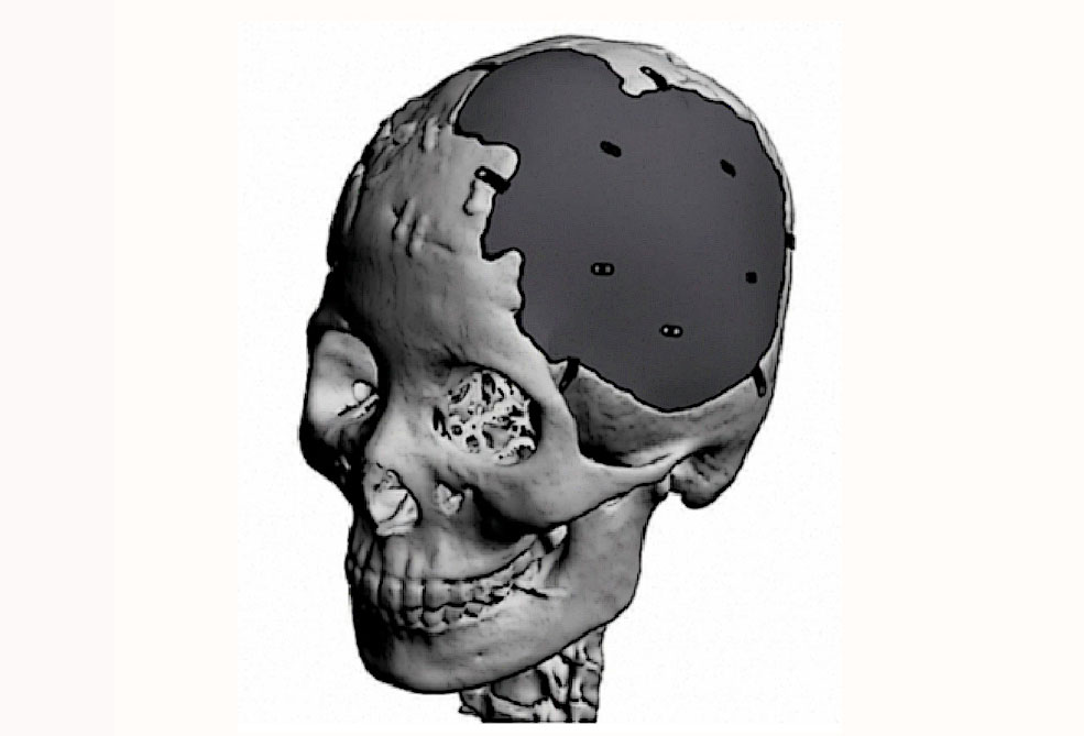 인체이식 이미지