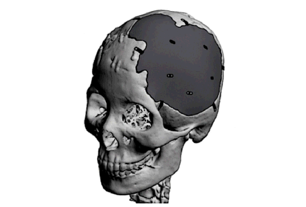 인체이식 이미지